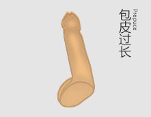 呼和浩特二轻男科医院解决了我的包皮困扰