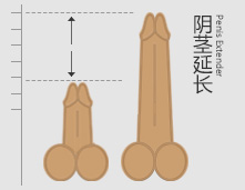 EPS阴茎延长术解救短小男人