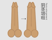 阴茎细小让他与美好姻缘擦肩而过