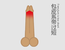 包皮系带过短，惧怕房事