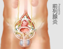 前列腺通畅，我的生活也通畅了