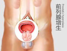 电切术治愈多年前列腺增生
