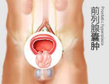 没有前列腺囊肿一身轻啊