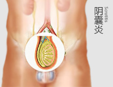 阴囊瘙痒不再是难“炎”之隐