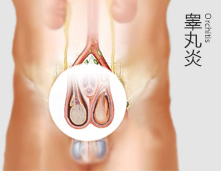 治疗睾丸炎，首选渗透疗法