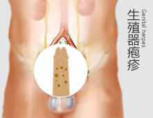一夜风流染上疱疹，妻子也遭罪