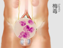 一夜放纵致梅毒缠身，我又该何去何从