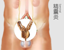 精囊炎 让我不能安心做爸爸